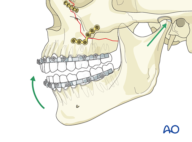 Le Fort II: Open reduction internal fixation - fixation 