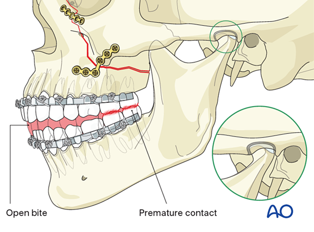 Le Fort II: Open reduction internal fixation - fixation 