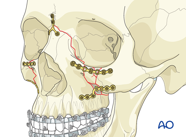 Le Fort II: Open reduction internal fixation - comminuted fractures