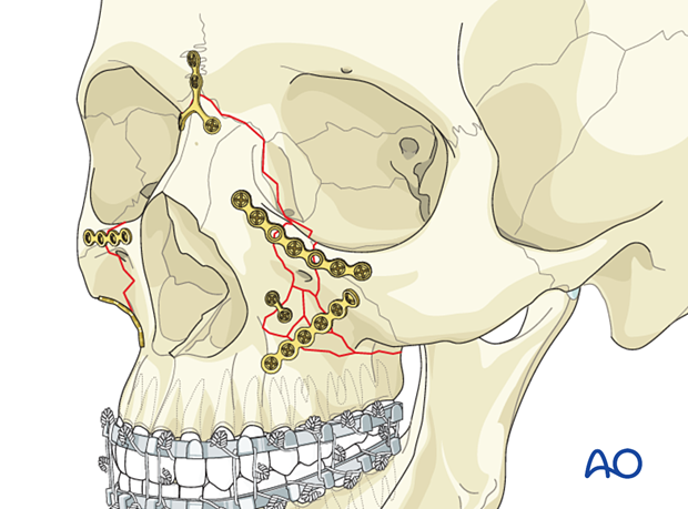 Le Fort II: Open reduction internal fixation - comminuted fractures