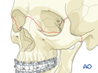 approach to the le fort i level of the midface in cleft lip and palate patients
