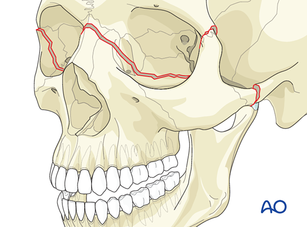 Le Fort III Open reduction internal fixation - Principles