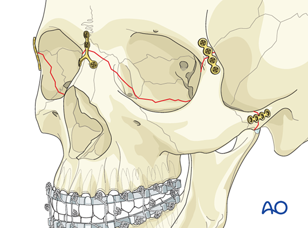 Le Fort III Open reduction internal fixation - Fixation