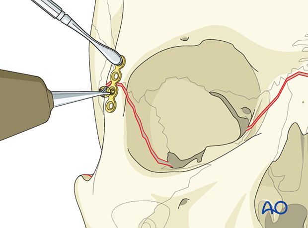 Le Fort III Open reduction internal fixation - Fixation