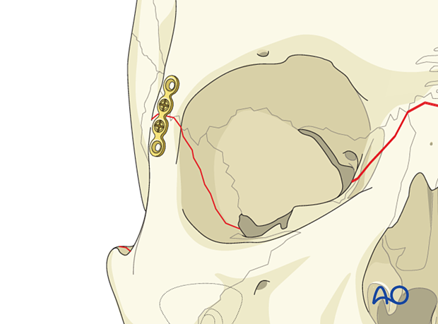 Le Fort III Open reduction internal fixation - Fixation