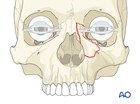 approach to the le fort i level of the midface in cleft lip and palate patients