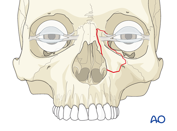Nasoorbitoethmoid type I nondisplaced fracture.