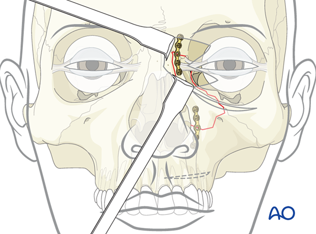 NOE Type I: ORIF - Fixation