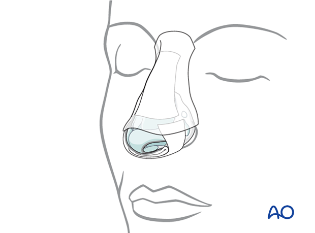 Splinting of a nasal bone fracture.