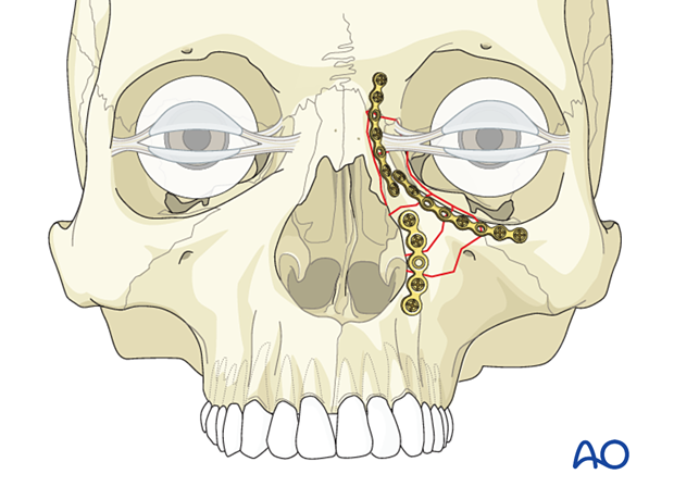 3-point fixation of a nasoorbitoethmoid type II fracture.