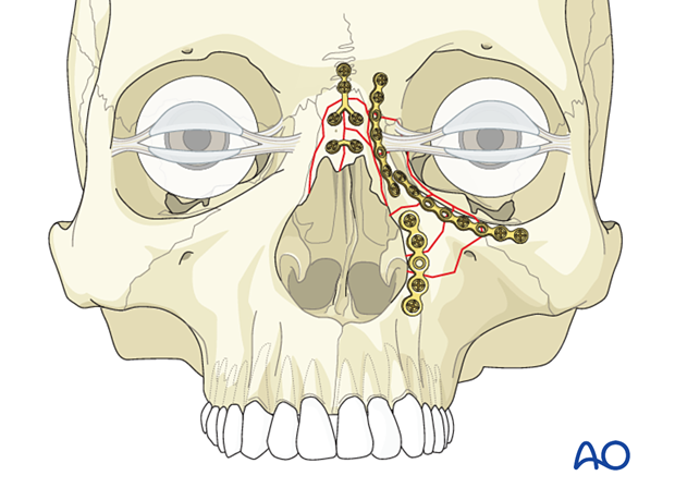 Fixation of a nasoorbitoethmoid type II fracture with nasal bone involvement using plates.