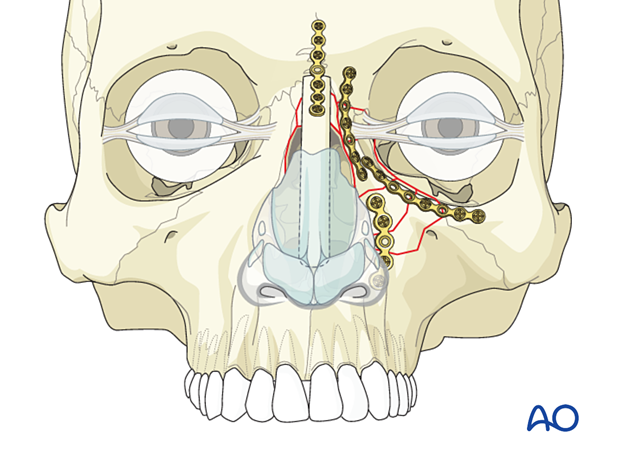 Fixation of a nasoorbitoethmoid type II fracture with nasal bone involvement using plates and a dorsal nasal bone graft.