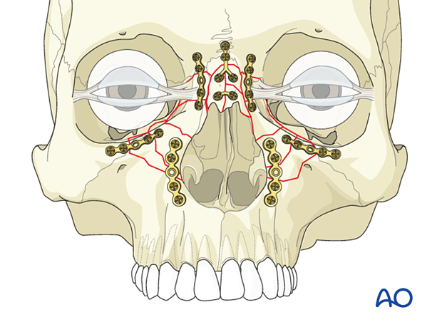 Fixation of a bilateral nasoorbitoethmoid type II fracture with nasal bone involvement using plates.