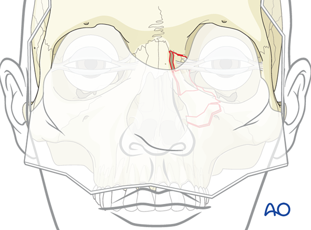 Exposure of the nasoorbitoethmoid type II fracture site.