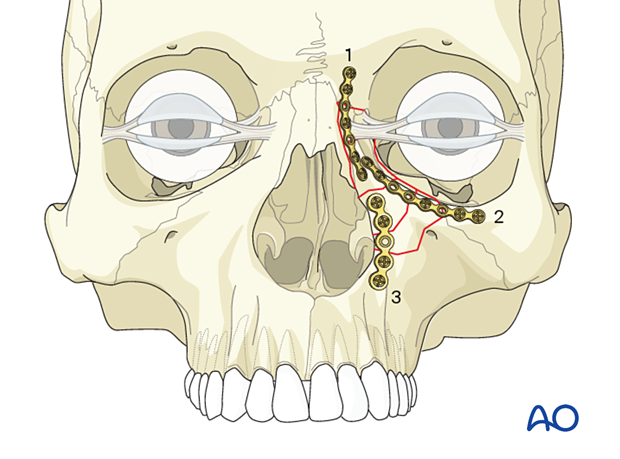 Order of plate fixation for a nasoorbitoethmoid type II fracture.