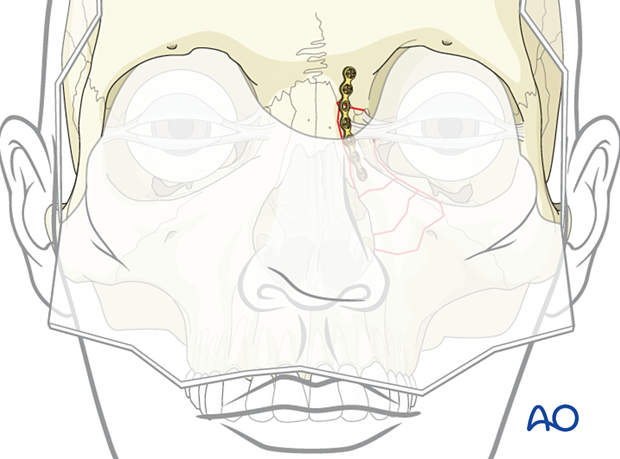Placement of the first plate of a 3-point fixation of a nasoorbitoethmoid type II fracture.