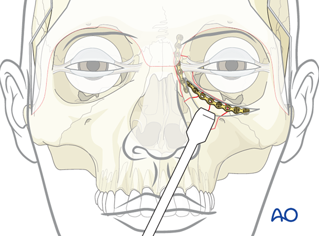 Placement of the second plate of a 3-point fixation of a nasoorbitoethmoid type II fracture.