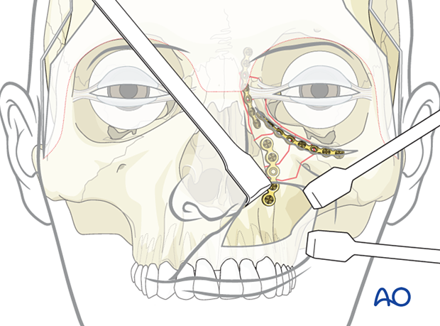 Placement of the third plate of a 3-point fixation of a nasoorbitoethmoid type II fracture.