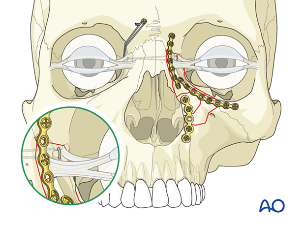 Fixation of a nasoorbitoethmoid type II fracture with nasal bone involvement using plates and a canthopexy transnasal wire.