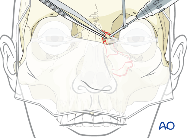 Holding the fragment with forceps, drill two holes in the bony fragment posterior to the attachment of the medial canthal ligament - nasoorbitoethmoid type II fracture. 