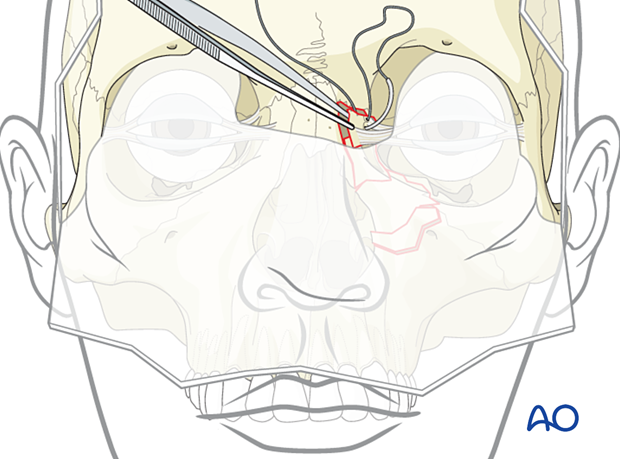 Passing the wire through the bone fragment hole - transnasal canthopexy for a nasoorbitoethmoid type II fracture.