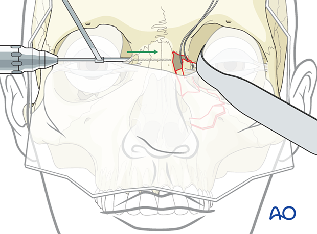 Drilling a hole from the contralateral side - transnasal canthopexy for a nasoorbitoethmoid type II fracture.