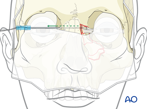 Pulling the spinal needle and wire out of the contralateral side - transnasal canthopexy for a nasoorbitoethmoid type II fracture.