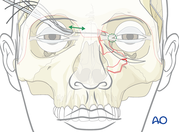 Confirm the correct position of the medial canthus - transnasal canthopexy for a nasoorbitoethmoid type II fracture.