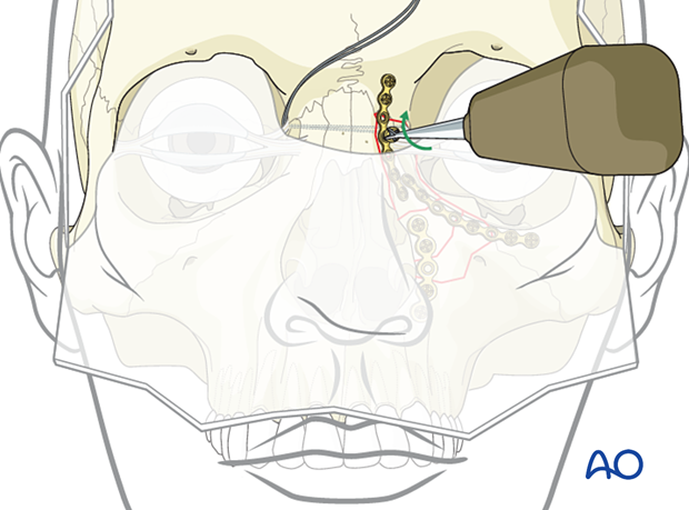 Screw insertion in the second plate - transnasal canthopexy for a nasoorbitoethmoid type II fracture.