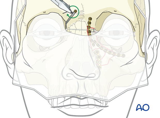 Securing the transnasal wire to a screw placed in the frontal bone on the contralateral side - nasoorbitoethmoid type II fracture.