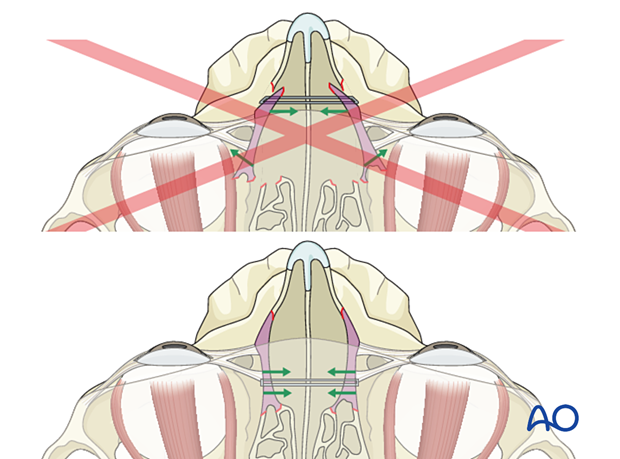 Proper AP position of transnasal wire - nasoorbitoethmoid fracture.
