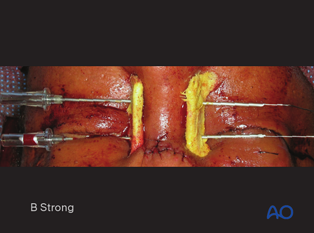 Clinical photograph showing percutaneous bolster dressing fixed in place with the use of transnasal wires during of transnasal wire canthopexy - nasoorbitoethmoid type II fracture.
