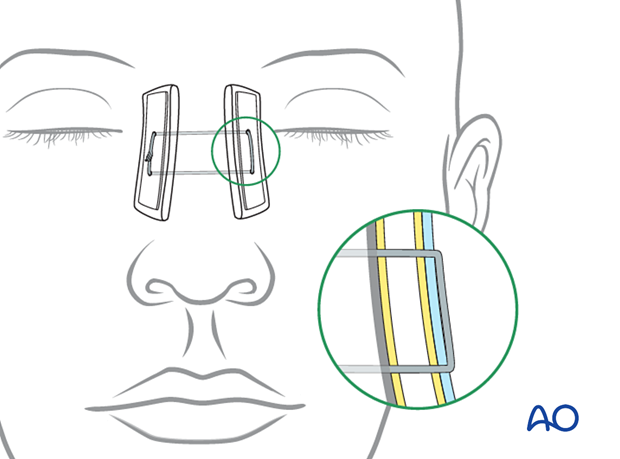 Percutaneous bolster dressings for transnasal wire canthopexy - nasoorbitoethmoid type II fracture.