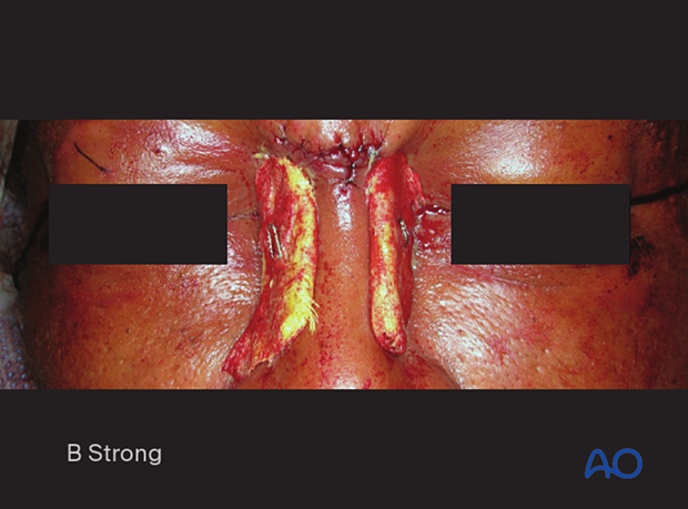 Clinical photograph showing the application of a percutaneous bolster dressing during of transnasal wire canthopexy - nasoorbitoethmoid type II fracture.