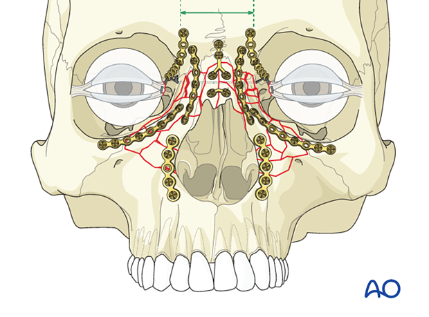 Fixation of a bilateral nasoorbitoethmoid type III fracture with nasal bone involvement using plates.