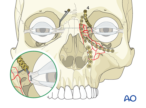 Fixation of a nasoorbitoethmoid type III fracture with nasal bone involvement using plates and a canthopexy transnasal wire.