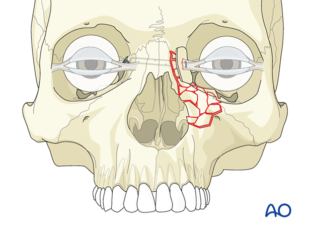 Supporting the transnasal canthopexy wire using a bone graft to reconstruct the bone bearing the canthal ligament - transnasal canthopexy for a nasoorbitoethmoid type III fracture.
