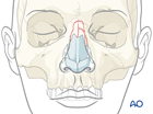 Nasal bone fracture