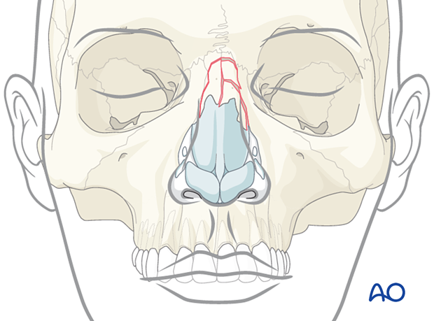 Nasal bone fracture