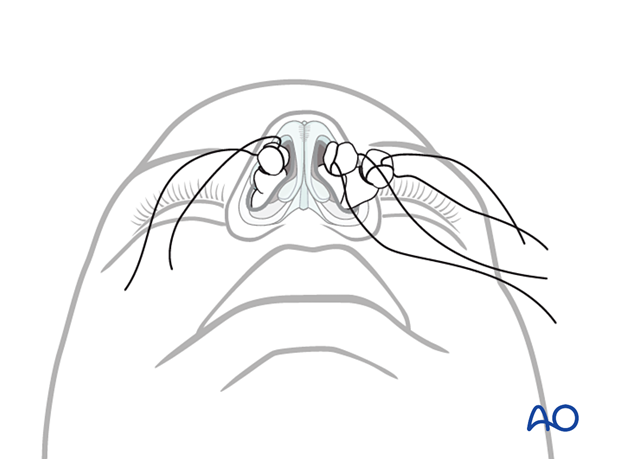 Nasal bone – closed reduction: General considerations