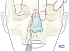 Nasal bone fracture with lateral displacement.