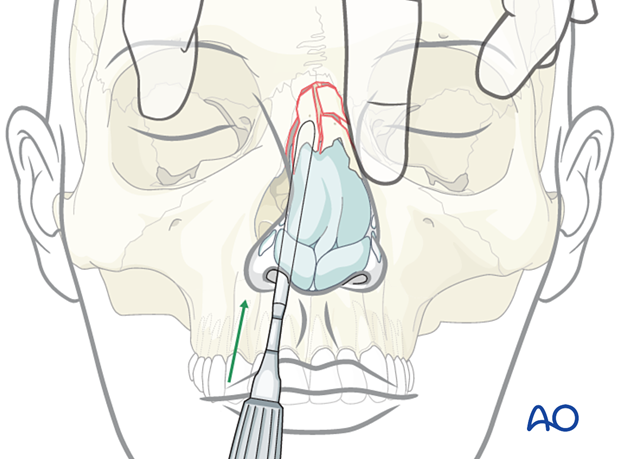 Reduction of a laterally displaced nasal fracture during reduction.