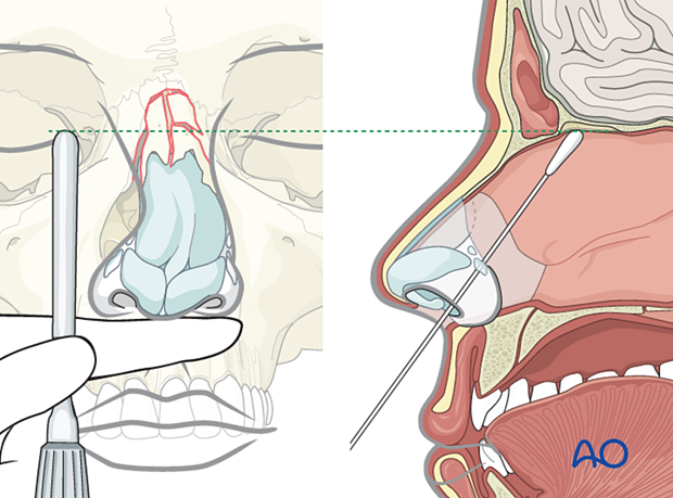 Determining the correct instrument placement during reduction of a laterally displaced nasal fracture.