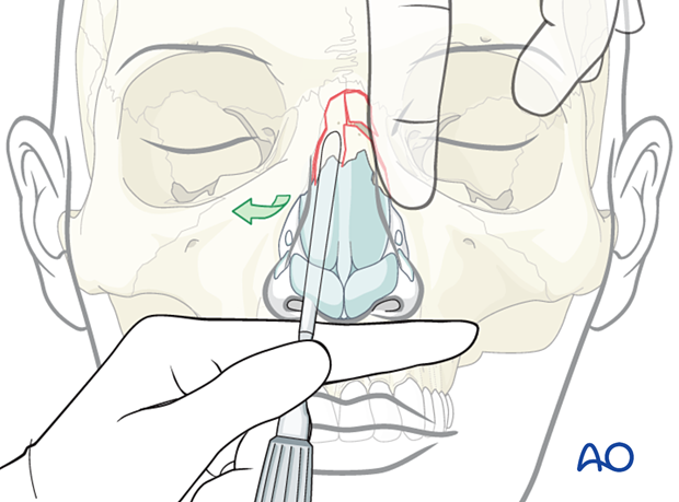 Raising the elevator up against the ipsilateral nasal bone and rotating the elevator during reduction of a laterally displaced nasal fracture.