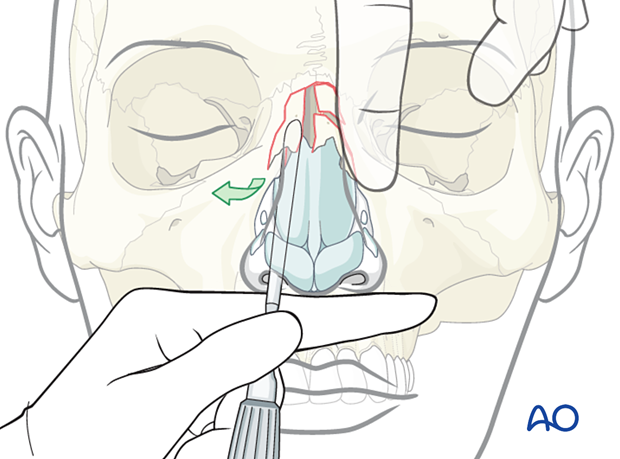Nasal bone remains outwardly dislocated and rotated away from the nasal septum during reduction of a laterally displaced nasal fracture.