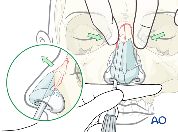 Palpably maneuvering the nasal bone toward the midline septum during reduction of a laterally displaced nasal fracture.