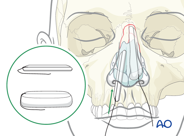 Packing material placed in nasal cavity between the septum and the nasal bone during reduction of a posteriorly displaced nasal fracture.