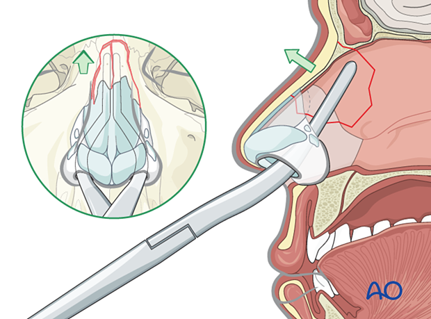 Elevating and disimpacting the dorsum with forceps during closed reduction of a posteriorly displaced nasal fracture.