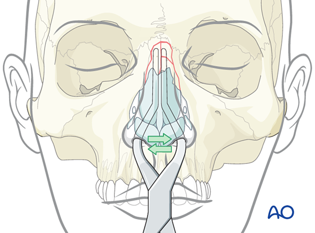 Straightening the nasal septum with forceps during reduction of the nasal septum.