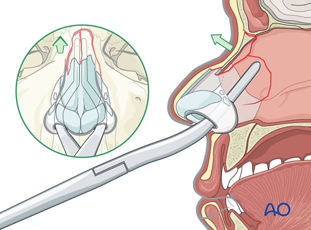 Elevating centrally depressed fractures with forceps during reduction of the nasal septum.